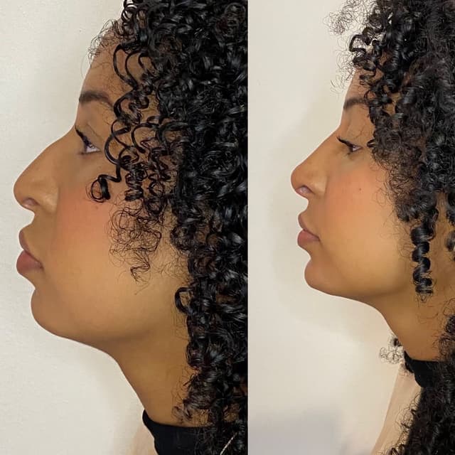 Antes e depois de perfiloplastia